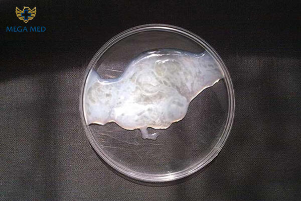 tinh dịch vón cục gây vô sinh